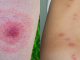 Experts say to call 911 if you see this mark on your skin