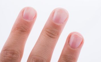 Nail signs that could be indicative of diabetes