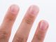 Nail signs that could be indicative of diabetes