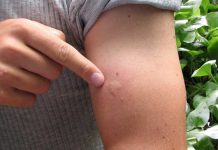 Recognize When Your Bug Bite Is More Serious Than You Thought