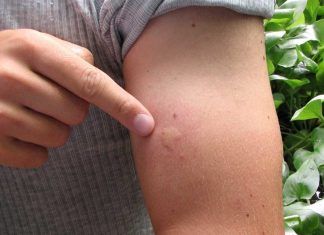 Recognize When Your Bug Bite Is More Serious Than You Thought