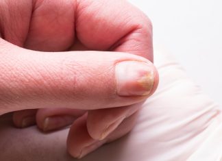 Warning Signs on Your Nails That Indicate Thyroid Issues