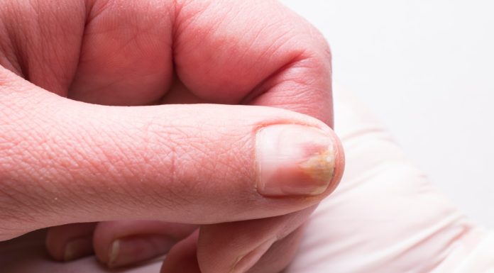 Warning Signs on Your Nails That Indicate Thyroid Issues